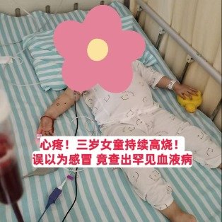 3岁女孩感染EB病毒引发罕见血液病