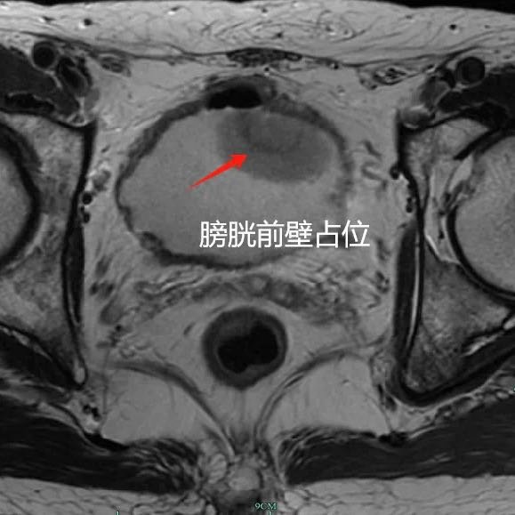 50岁男子忽视血尿拖成膀胱癌