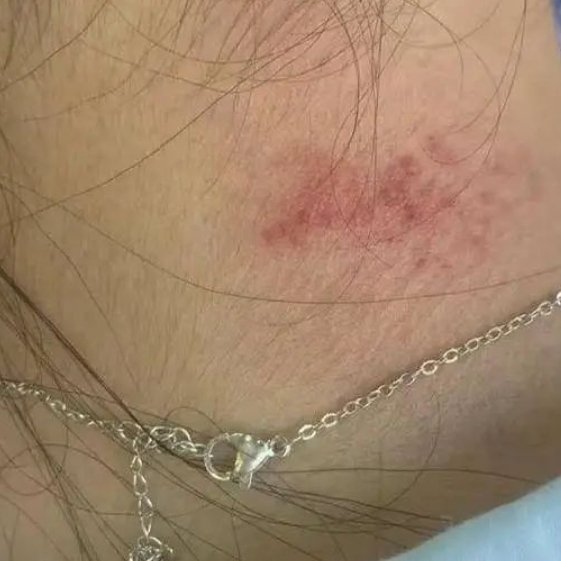 女子直播间买项链佩戴后得皮炎