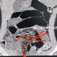 东莞一男子吃了两个番石榴后肠梗阻进院