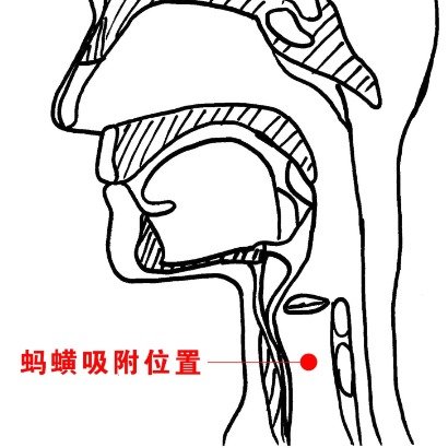 女子喉咙难受竟是因为藏了只活蚂蟥