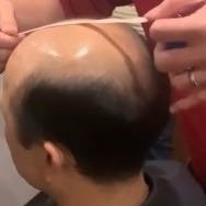 医生建议一年染烫发别超2次