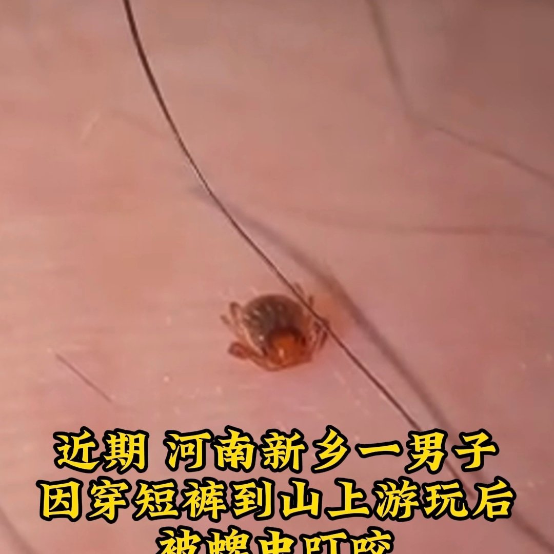 新乡一男子穿短裤爬山被蜱虫咬伤