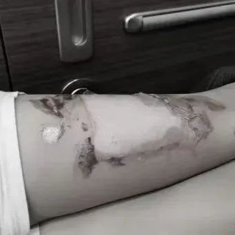 女童高铁上烫伤河南医学生接力救助