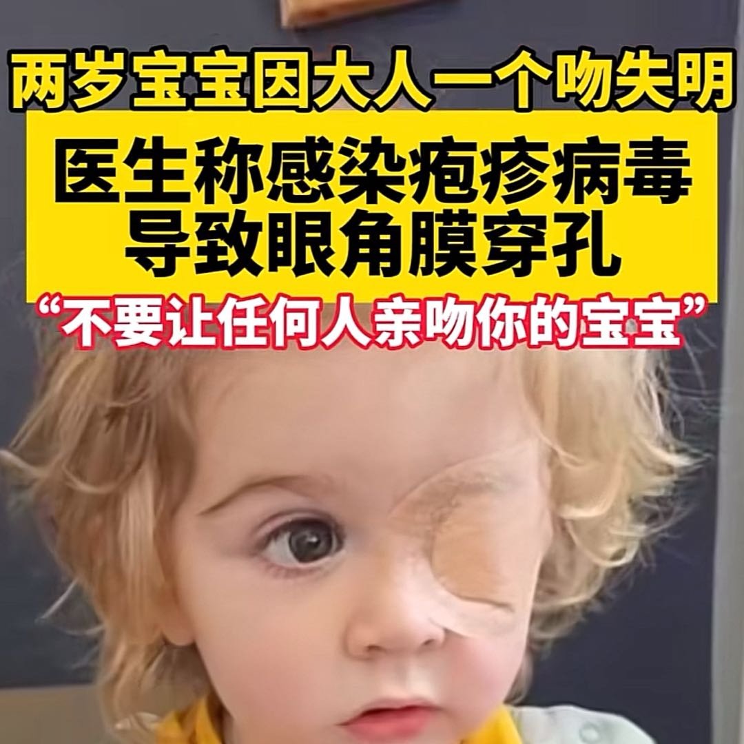 2岁男童因大人一个亲吻左眼失明
