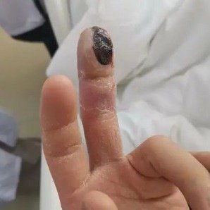 这种感染拖延3天死亡率近100%