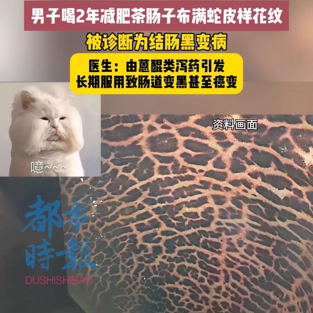 男子喝2年减肥茶肠子布满蛇皮样花纹