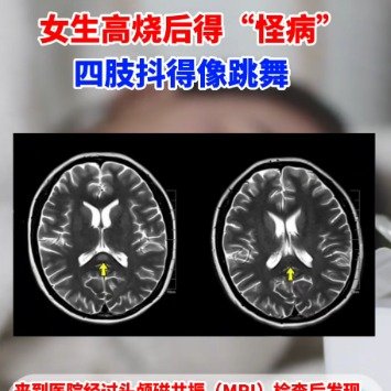东莞女生高烧后得怪病四肢抖得像跳舞