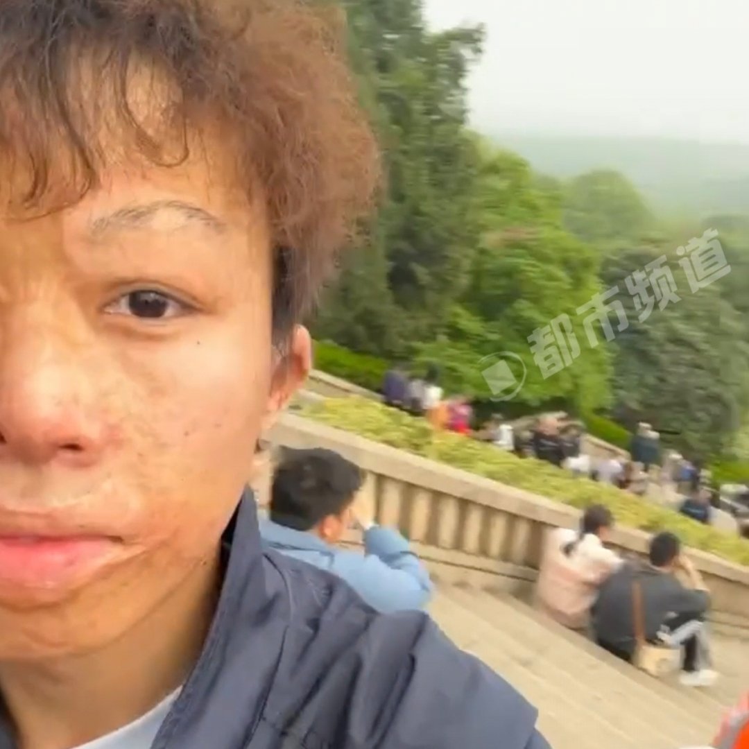 烧伤男孩鼓起勇气在景点自拍打卡