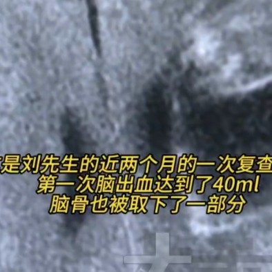 丈夫摔成植物人妻子不离不弃唤醒