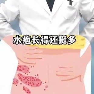 为什么年纪越大越容易得带状疱疹