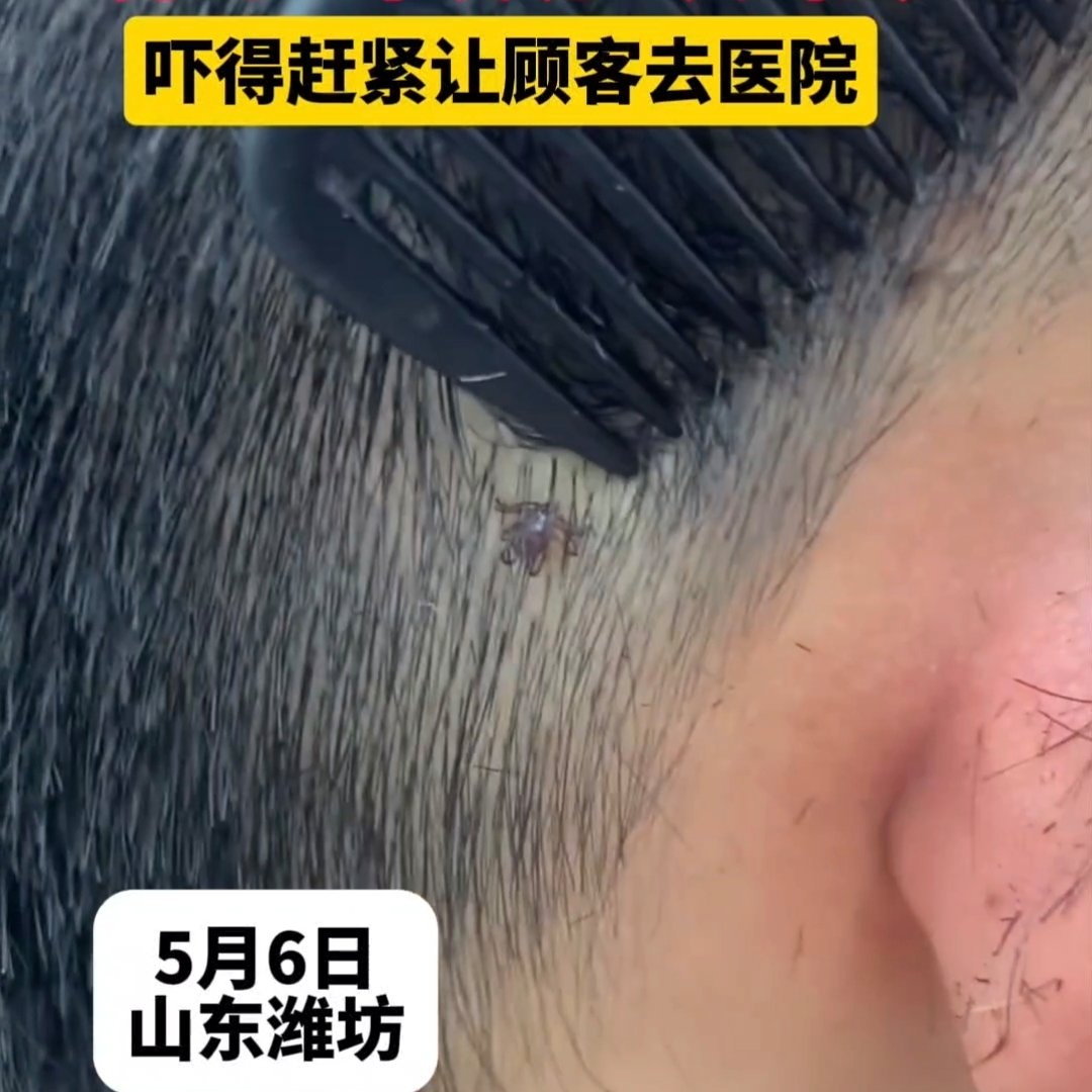 理发剪到一半发现一只蜱虫