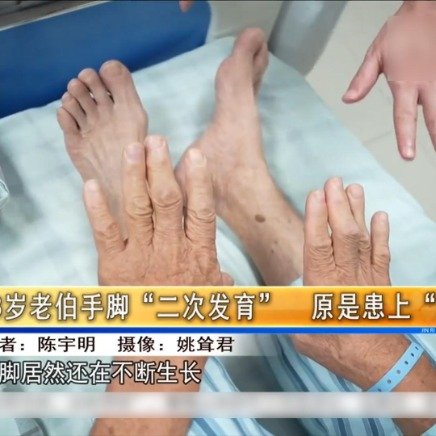 68岁阿伯患巨人症手脚不断长大