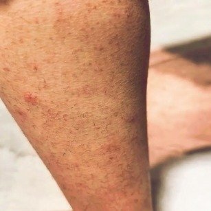 男子因保暖裤腿毛消失还进了医院