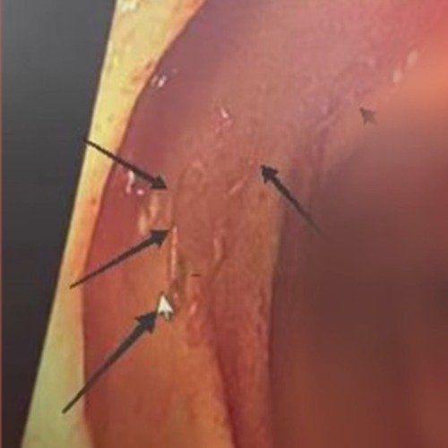 阿姨肚子里惊现十几条蠕动活虫