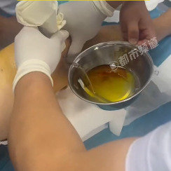 男子痛风膝盖挤出半盆黄油