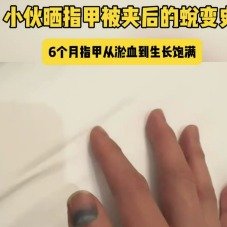 小伙晒指甲被夹乌黑后的6个月蜕变