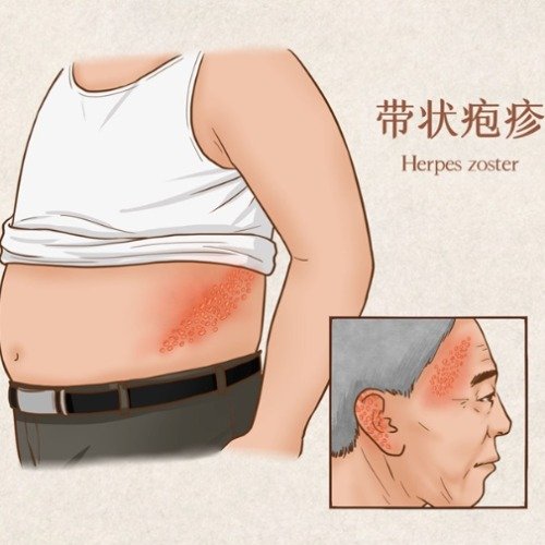 带状疱疹遇三高后果比想象更严重