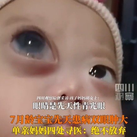 7月龄宝宝先天患病双眼肿大