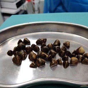 女子把奶茶当续命水患上胆囊结石