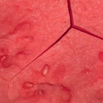 6岁男孩把西瓜当饭吃致尿床两周