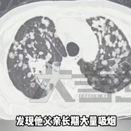 男孩长期吸二手烟致基因突变患肺癌