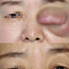 65岁老人左眼长鸡蛋大肿瘤19年